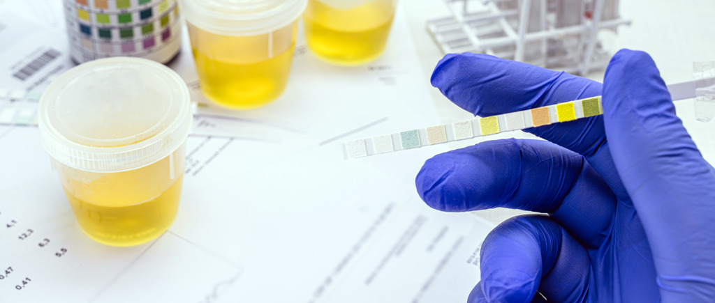 Exames de urina, quais são e para que servem